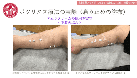 痛み止めの塗布の実際（下肢の場合）の写真2点。マーキングした場所に白いクリームを塗った状態と、その上をラップで覆いテープで固定した状態