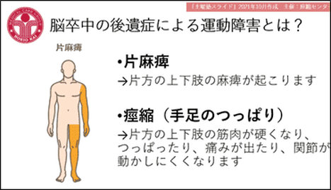 脳卒中の後遺症による運動障害の説明図。片方の上下肢に麻痺が起こる「片麻痺」と、片方の上下肢の筋肉が硬くなりつっぱる「痙縮」の2つを、人体図で示している