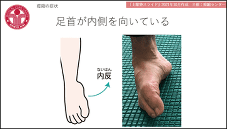 痙縮の症状の図と写真。足首が内側にねじれる「内反」の状態を、イラストと実際の足の写真で示している