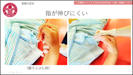 痙縮の症状の写真。手指が握りこぶしの形のまま固まり、伸ばそうとしても指が伸びにくい状態